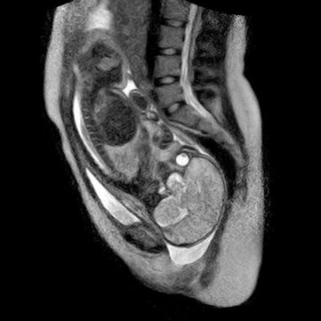 Erste Geburt im Kernspin an der Berliner Charité