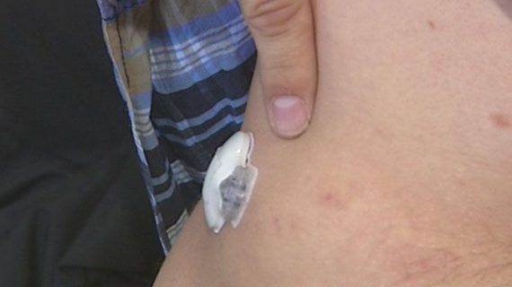 Intelligentes Diabetes-Pflaster