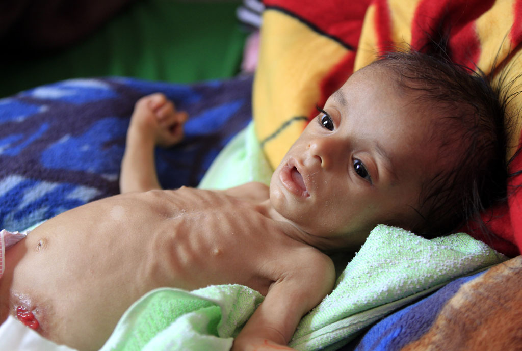Hungerkatastrophe im Jemen