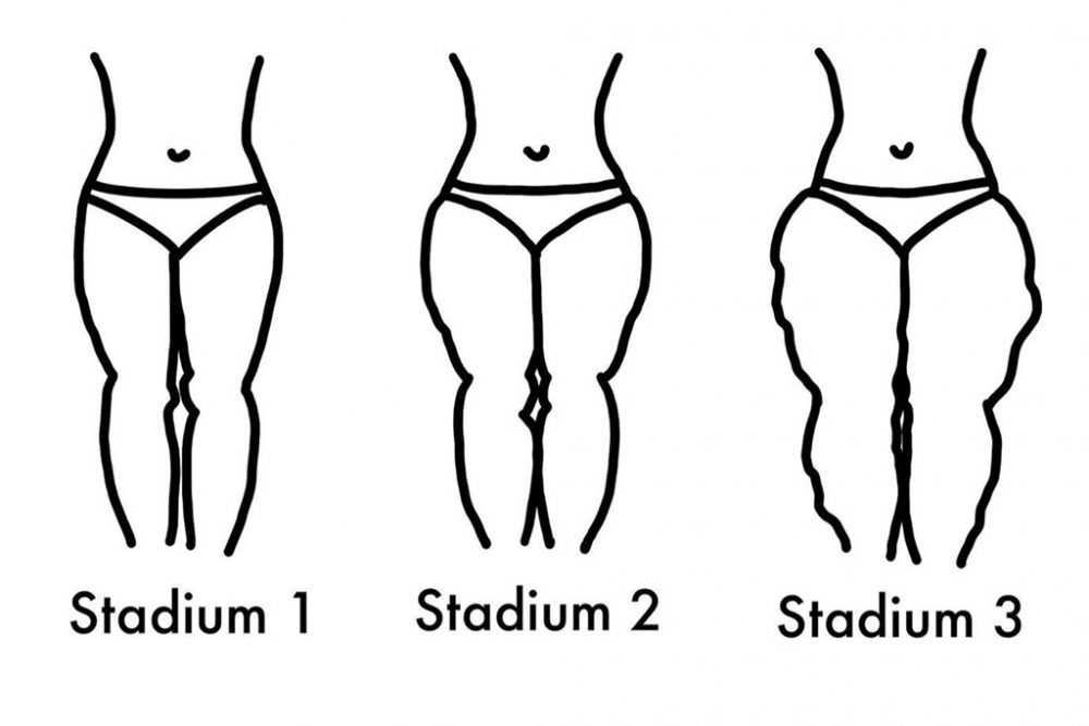 Die drei Stadien eines Lipödems (Illustration: Nina Rodermann)