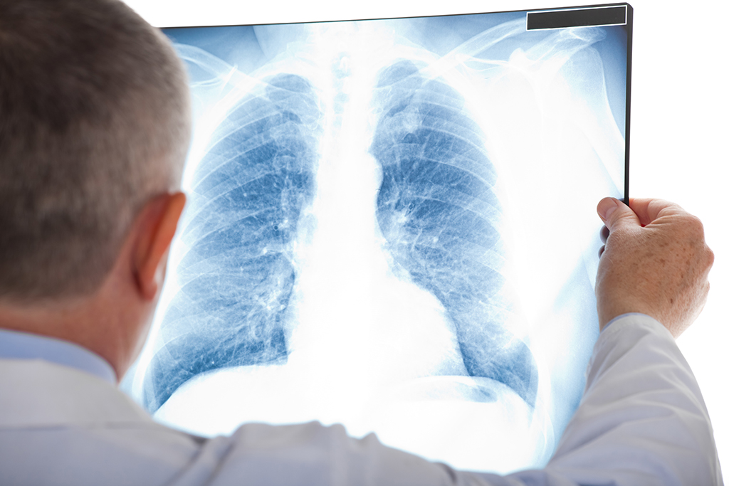 Röntgenbild der Lunge (Illustrationsbild: minervastock/PantherMedia)