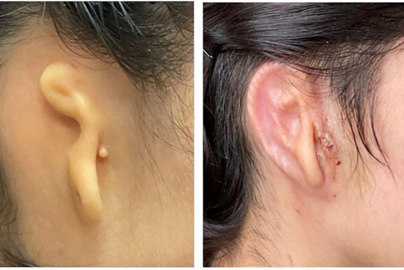 Das Bild zeigt das Ohr der Patientin vor dem Eingriff (li.) und 30 Tage nach der Operation (re.) (Bild: Kristi Bruno/Congenital Ear Institute/AFP)