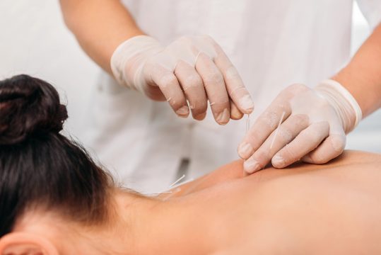 Bei einer Frau wird eine Akupunkturbehandlung durchgeführt